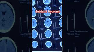 Brain Ct Mystery Can You Spot The Subdural Hygroma?