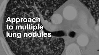 Algorithmic Approach To Multiple Lung Nodules