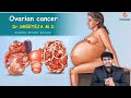 Ovarian Cancer Part 1 : Obstetrics and gynaecology Video lectures