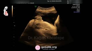 Kız bebek ultrasonografide nasıl görünür? ("Hamburger sign" = dış genital bölge yani labium majus)
