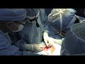 2013 Moreano World Medical Mission Ear Reconstruction using Rib Cartilage