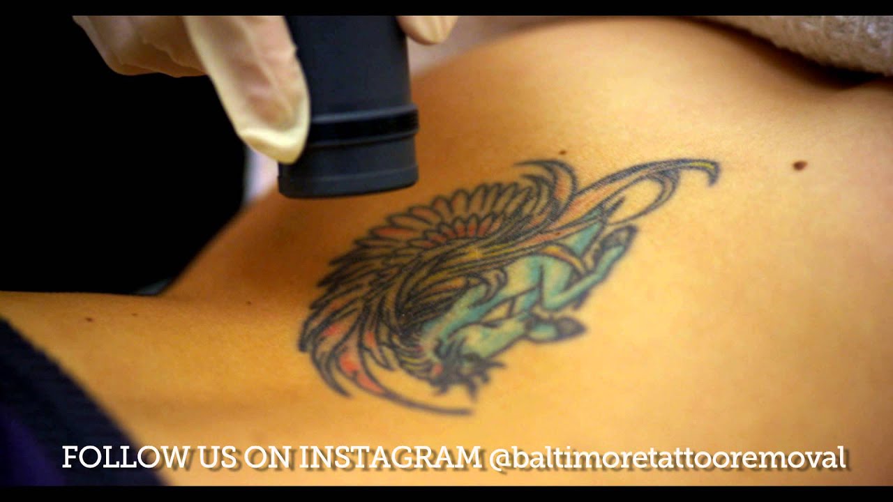 baltimore tattoo removal female patient interview youtube baltimore tattoo removal female patient interview youtube