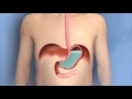 Heartburn, Acid Reflux, GERD-Mayo Clinic