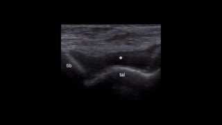 Concomitant Tibiotalar Joint Effusion And A Partial Tear Of The Talonavicular Ligament At Us.