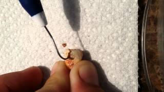 Epic tooth decay, scrapping food out of a cavity, tooth cavity