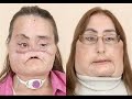 Charla Nash, Chimp Attack Victim