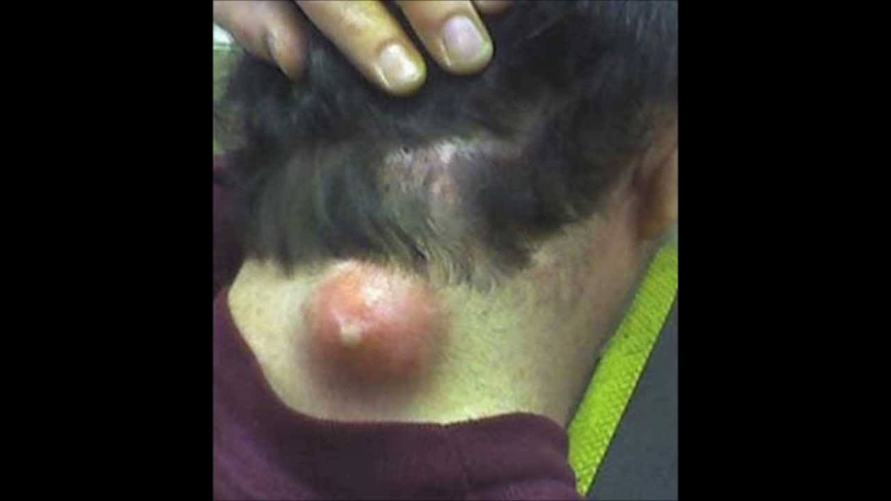nasty projectile stomach pus blackhead pop gross click nasty projectile stomach pus blackhead pop gross click