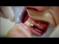 Embarrassing Bodies Dentist - Full Arch Implants. Part 1.