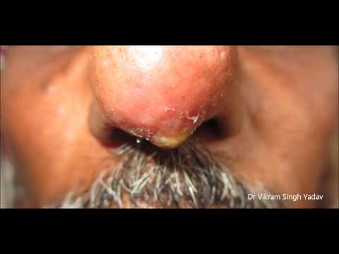 Boil On Nose Tip