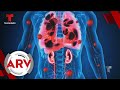 Coronavirus: El virus cuenta con 3 fases y produce daños en ...