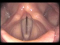Stroboscopy: Rigid: Normal female vocal cords - glide up