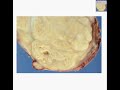 Histopathology Lymph node--Nodular sclerosis Hodgkin lymphom