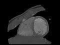 Multiple Giant Coronary Artery Aneurysms Due to Kawasaki Disease: Electrocardiogram-Gated 64-Slice