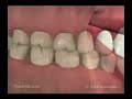 radiografias dentales tipo Bitewing X-rays dental advance clinica odontologica aimone diego