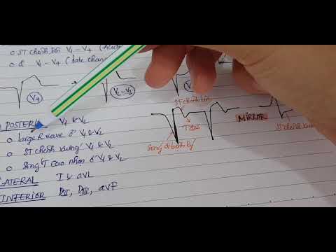 Tim mạch | Nhồi máu cơ tim | MI