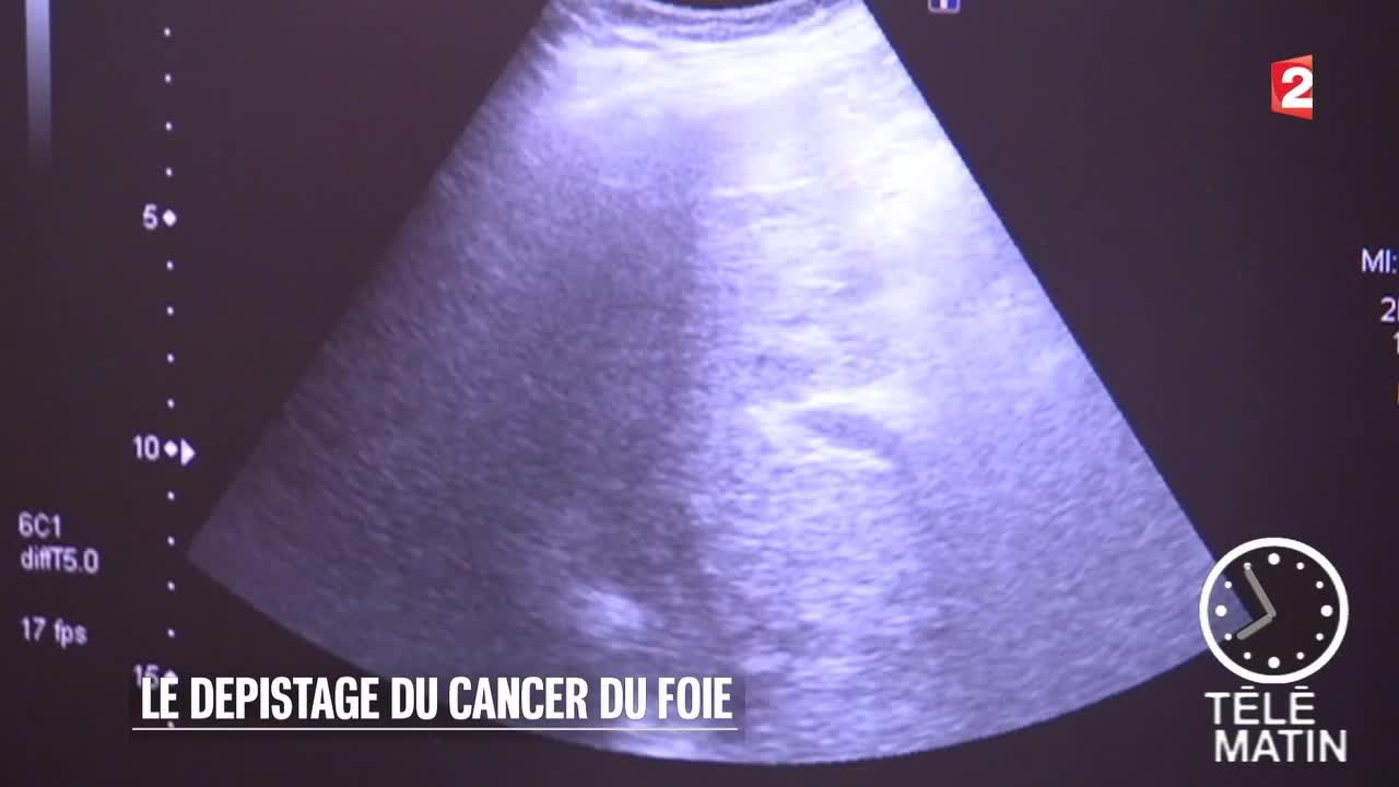 Traitement homeo chimio depistage most cancers du colon