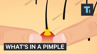 What's Inside A Pimple?