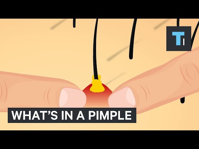 The Inside Of A Pimple (Gross!) - Video