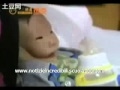 Kang Kang il bambino cinese nato con la maschera al volto
