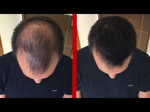 7 Formas De Detener La Caída Del Cabello En El Hombre