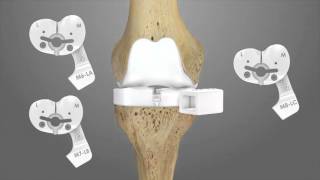 iTotal CR Total Knee Replacement Surgical Technique Animation | Conformis