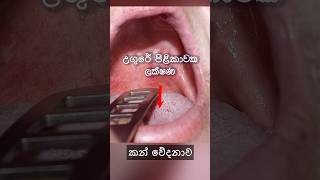 උගර පළක ලකෂණ Sore Throat Cancer Symptoms