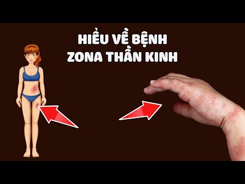 Hiểu về bệnh Zona thần kinh