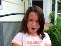 CHICKEN POX