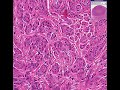 Histopathology Uterus --Leiomyoma