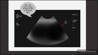 Bess Rodan Phantom Pregnancy Belly Expansion