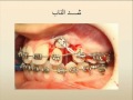 surgery exposure of buccal impacted canine
