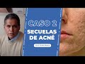 Testimonio: Tratamiento de cicatrices de acne con Improve Scar Peel No Laser - Lima Perú
