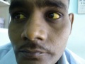 Jaundice Cured by Homeopathy Serum Bilirubin 44.7 Dr.Ravi Singh