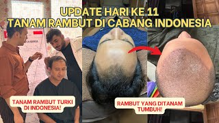 Masih Umur 20An Udah Botak? Begini Setelah Tanam Rambut Turki Di Indonesia