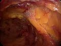 hernioplastia