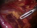 hernioplastia