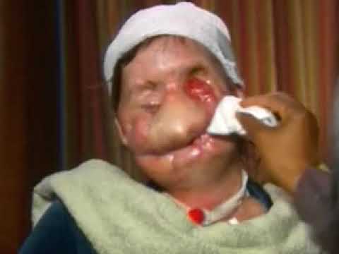 woman attacked by chimpanzee