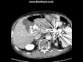 Acute Pancreatitis Balthazar Scoring | RM. Acute Pancreatitis Balthazar Scoring | RM.
