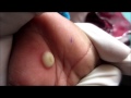 Should A Blister Be Popped