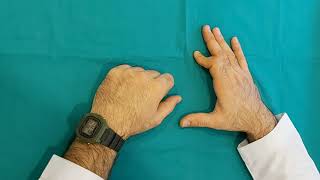 Parmakta tendon yaralanması sonrası sekil bozukluğu Düğme İliği Deformitesi
