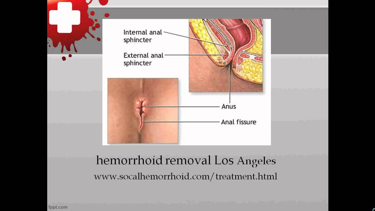 Does Hemorrhoids And Anal Sex