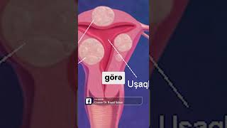 Mioma Uşaqlıq Şişi - Böyüdükcə Hansı Problemlərə Səbəb Olur?