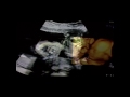 ultrasound 3d 4d