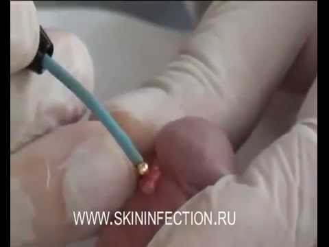 Как народная медицина лечит папилломы