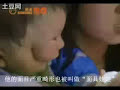 The Two-Faced Baby Boy from China (The Mask-Face Baby)