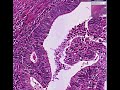 Histopathology Uterus--Endometrial adenocarcinoma