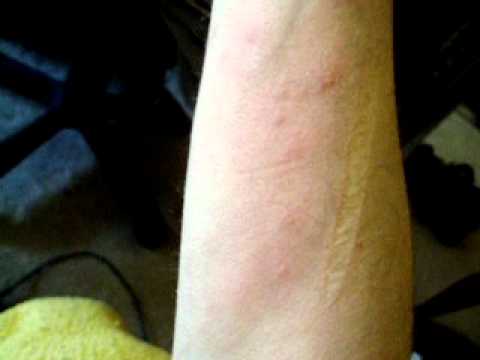 bird mites with scabies like symptoms bird mites with scabies like symptoms