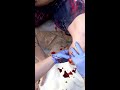 18+ Huge Abscess Rupture and Drainage in LBK Amputee 18+