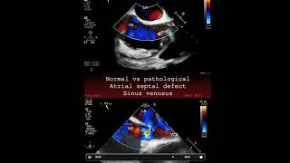 Normal Vs Pathological Atrial Septal Defect Sinus Venosus