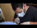 NeoGraft procedure at Paramount Plastic Surgery- Keith Jeffords, MD